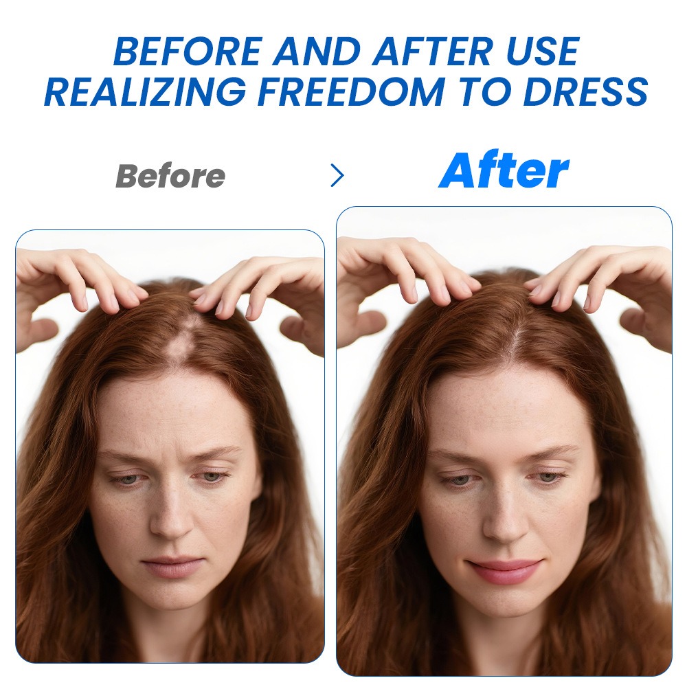 Alopecia Spray para el crecimi - Hair Care Spray reseña y precio