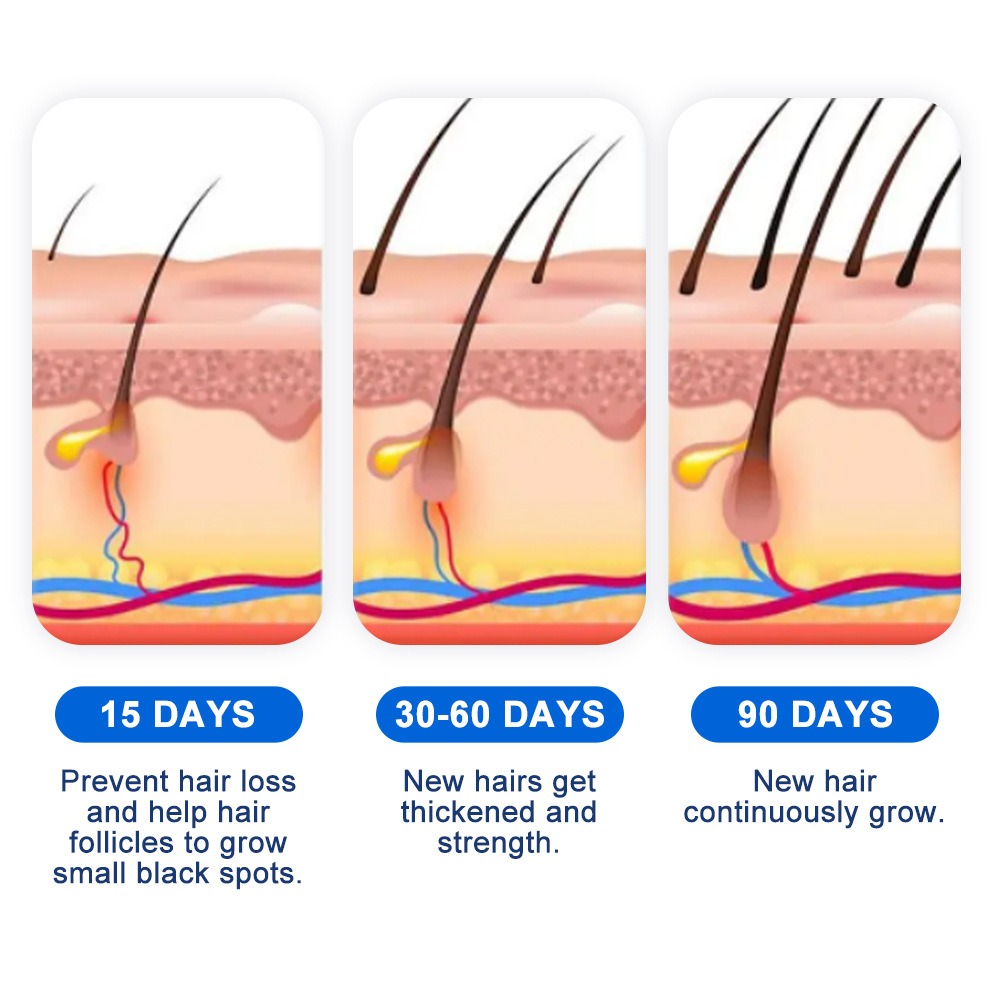 Alopecia Spray para el crecimi - Hair Care Spray reseña y precio